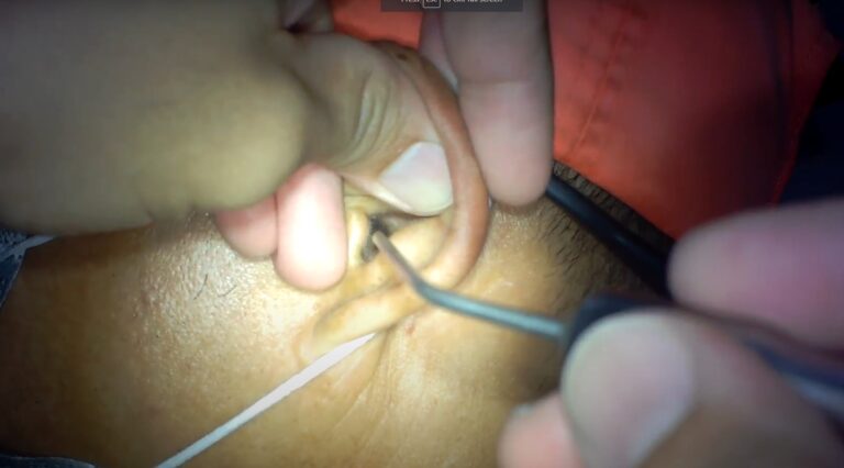 Earwax Removal Cebu City