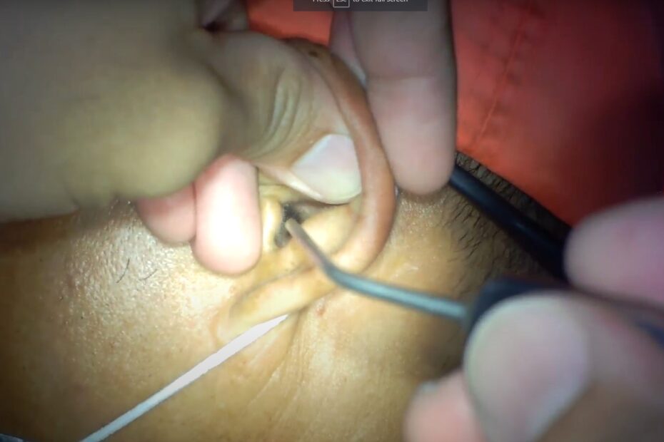 Earwax Removal Cebu City